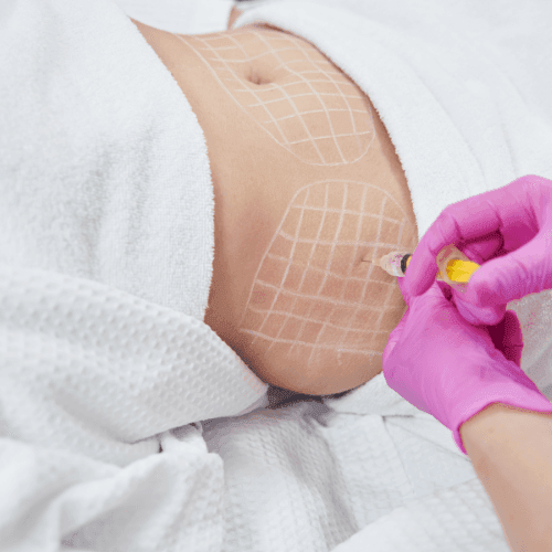 Healthcare professional wearing pink gloves administering an injection to a patient's abdomen marked with grid lines.